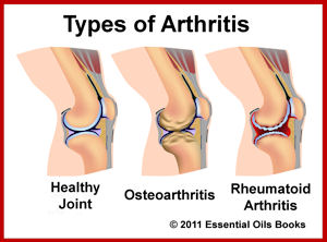 what is psoriatic arthritis #11